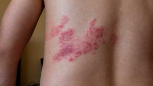 Pessoas com mais de 50 anos devem tomar vacina contra herpes zóster (cobreiro) para evitar sintomas e outras complicações